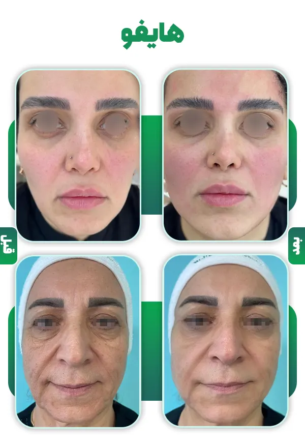 قبل و بعد هایفو