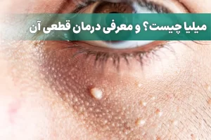 میلیا و درمان آن