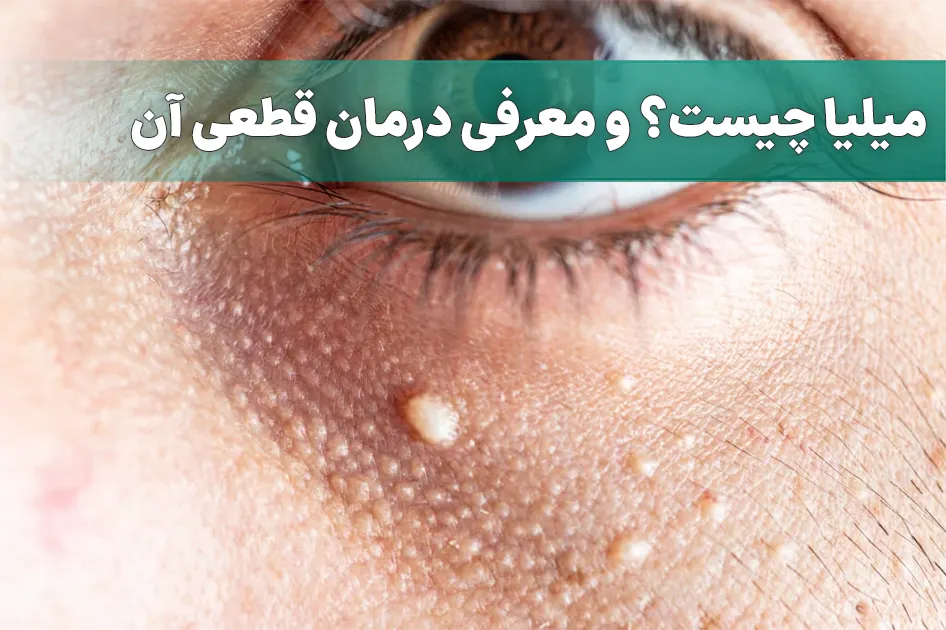 میلیا و درمان آن