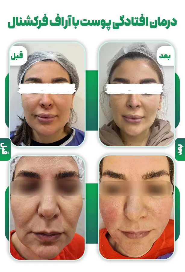 قبل و بعد آر اف فرکشنال