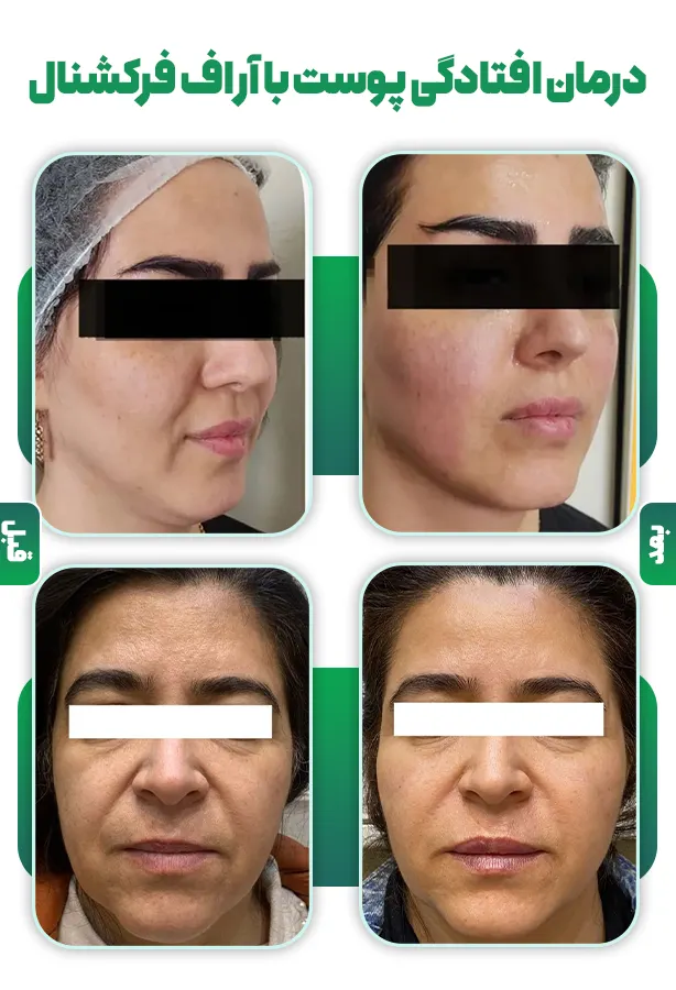 قبل و بعد آر اف فرکشنال