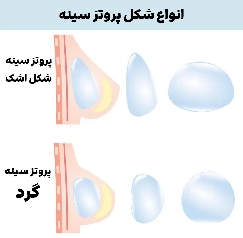 انواع شکل پروتز سینه