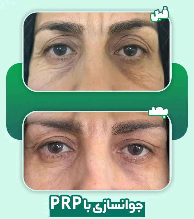 جوانسازی با PRP