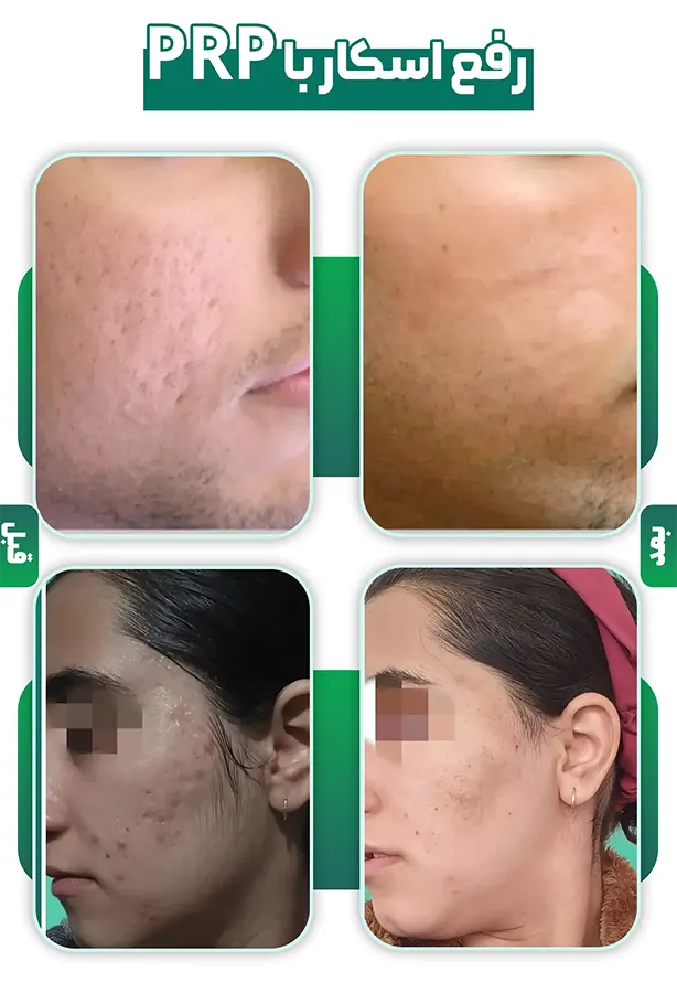 درمان اسکار آکنه با PRP