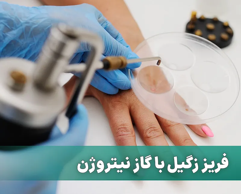 درمان زگیل با گاز نیتروژن