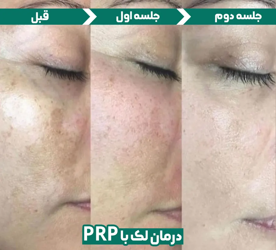 درمان لک صورت با prp
