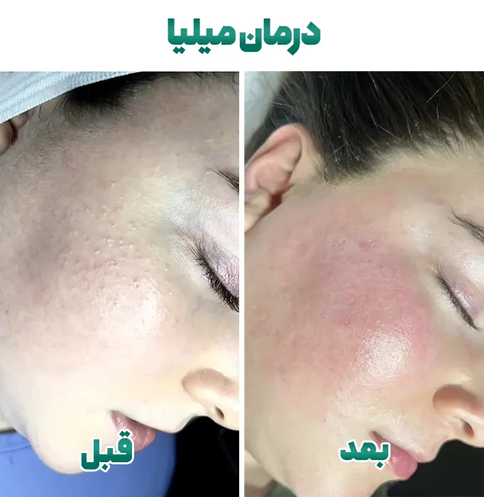 قبل و بعد درمان میلیا