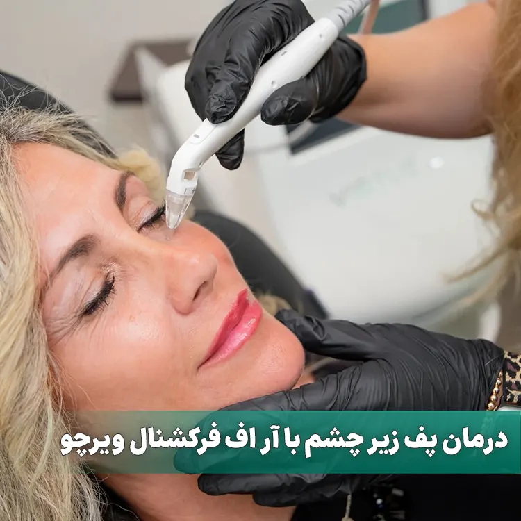 درمان پف زیر چشم با آر اف فرکشنال ویرچو