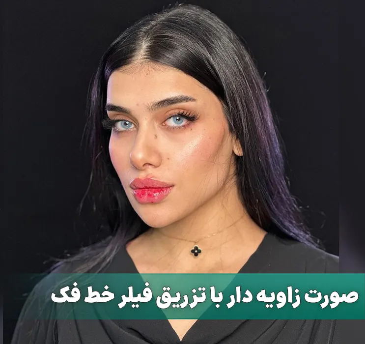 صورت زاویه دار با تزریق فیلر خط فک