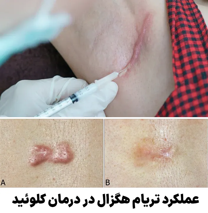 عملکرد تریام هگزال در درمان کلوئید