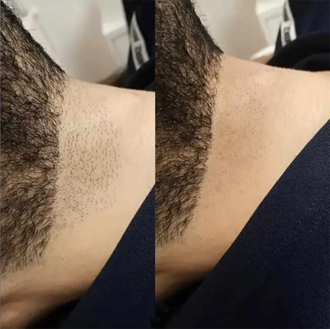 قبل و بعد لیزر خط ریش