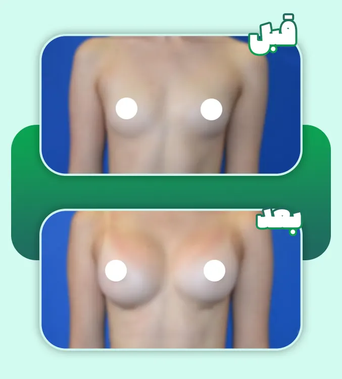 قبل و بعد پروتز سینه