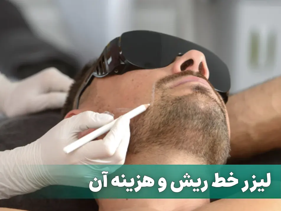 لیزر خط ریش و هزینه آن