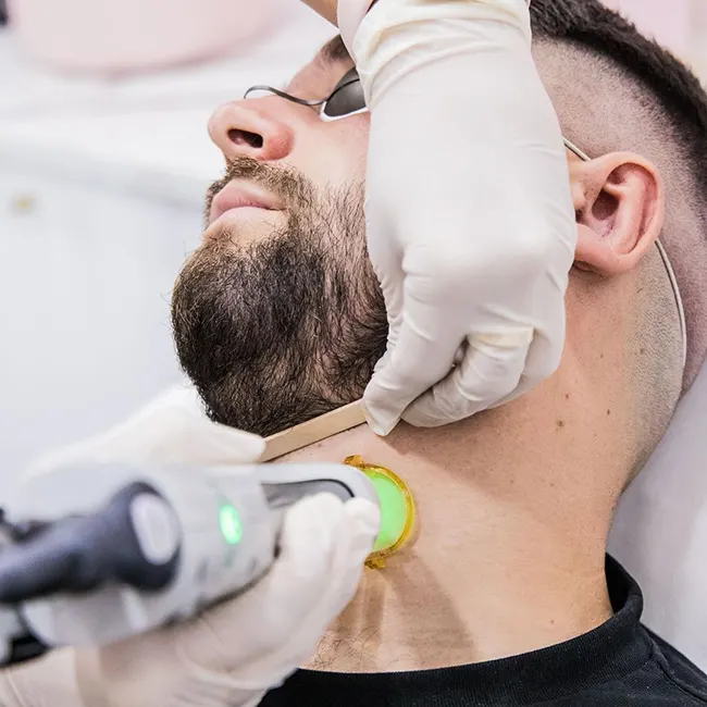 لیزر خط ریش