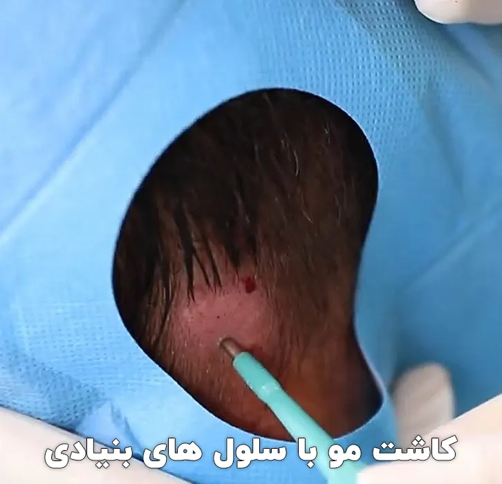 کاشت مو با سلول های بنیادی