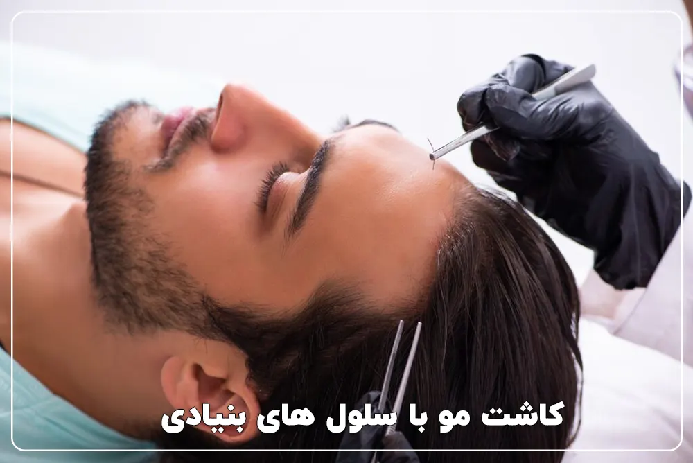 کاشت مو با سلول های بنیادی