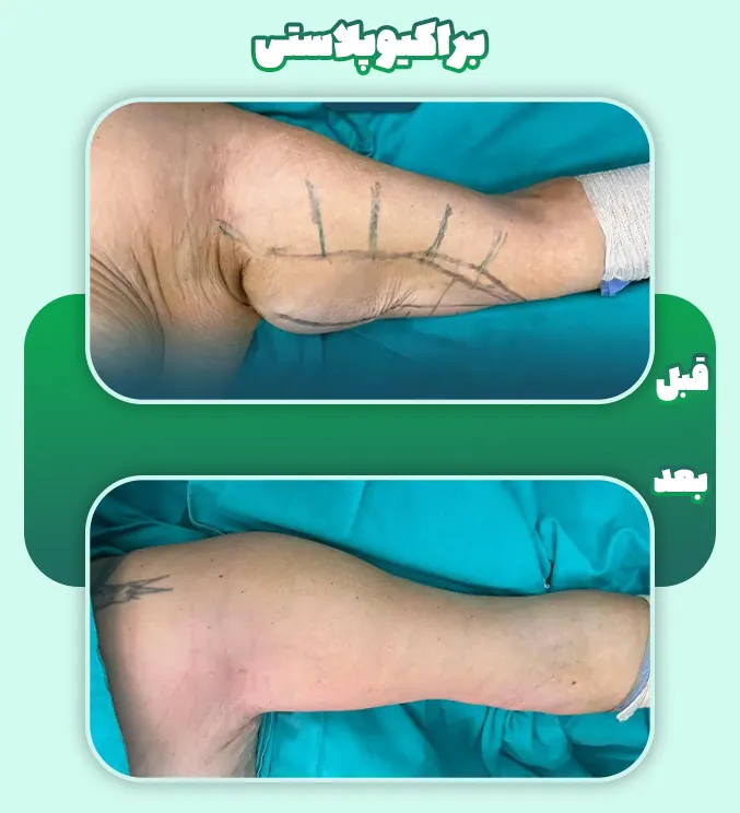 براکیوپلاستی قبل و بعد