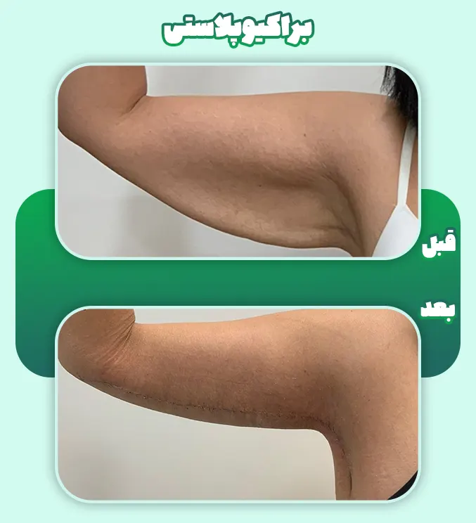 قبل و بعد براکیوپلاستی