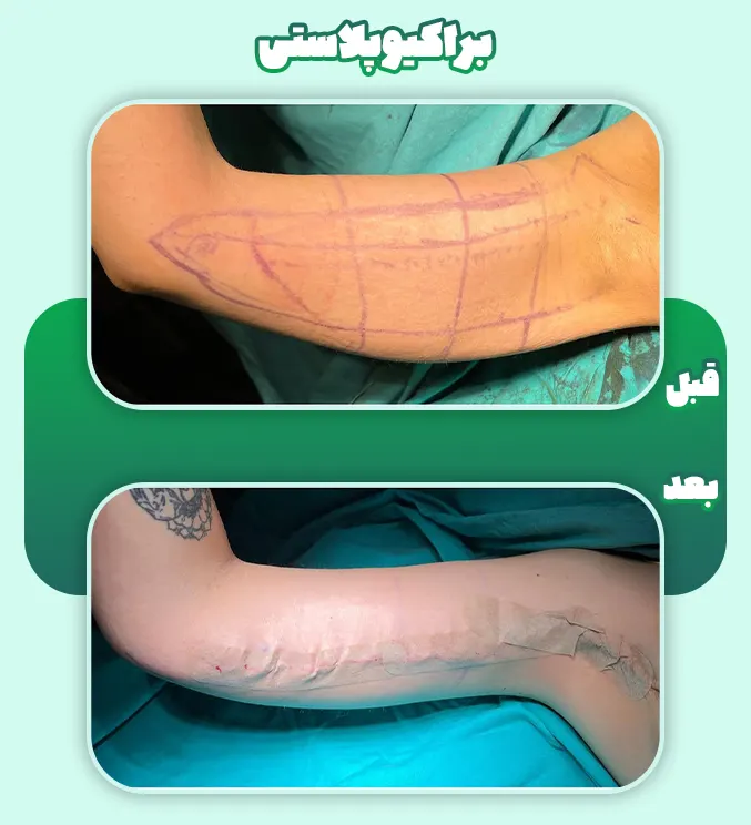 قبل و بعد جراحی لیفت بازو
