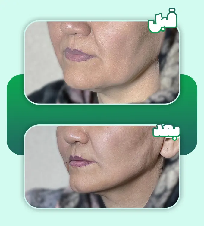 لیفت صورت با نخ