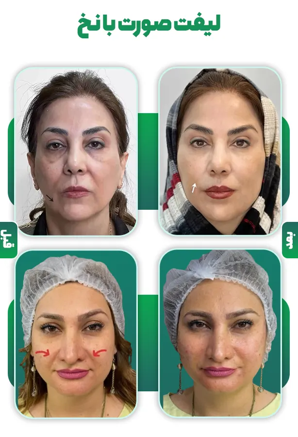 لیفت صورت با نخ