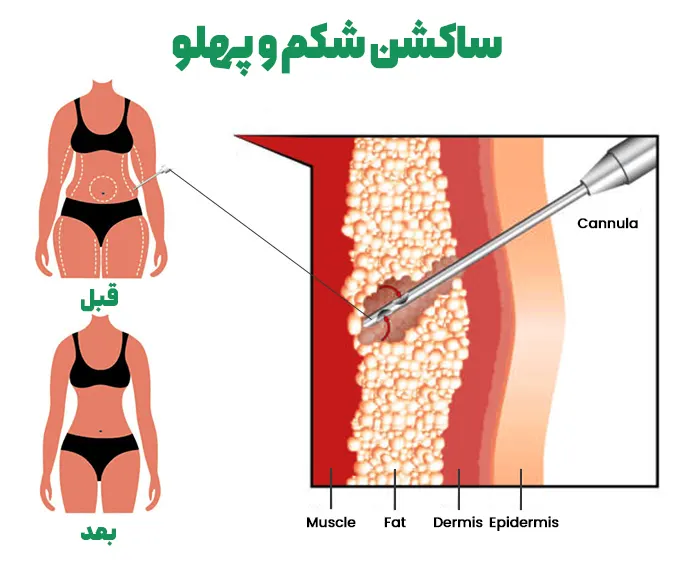 ساکشن شکم و پهلو