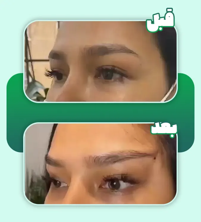 لیفت ابرو با نخ