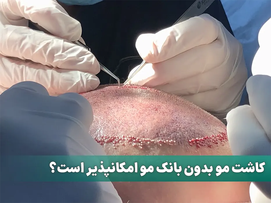 کاشت مو بدون بانک مو امکانپذیر است؟