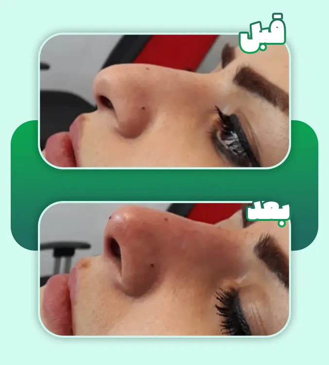 لیفت بینی با نخ