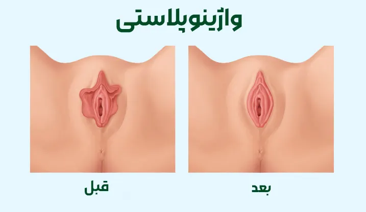 واژینوپلاستی