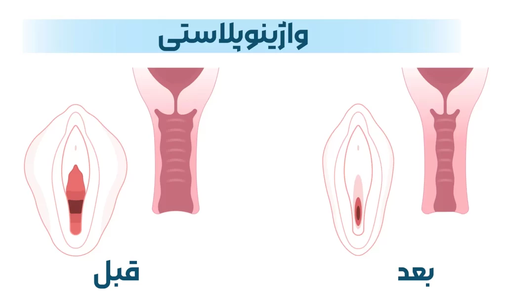 واژینوپلاستی