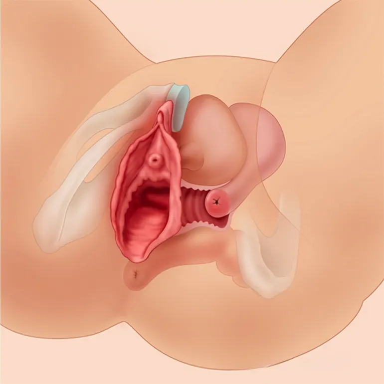 واژینوپلاستی