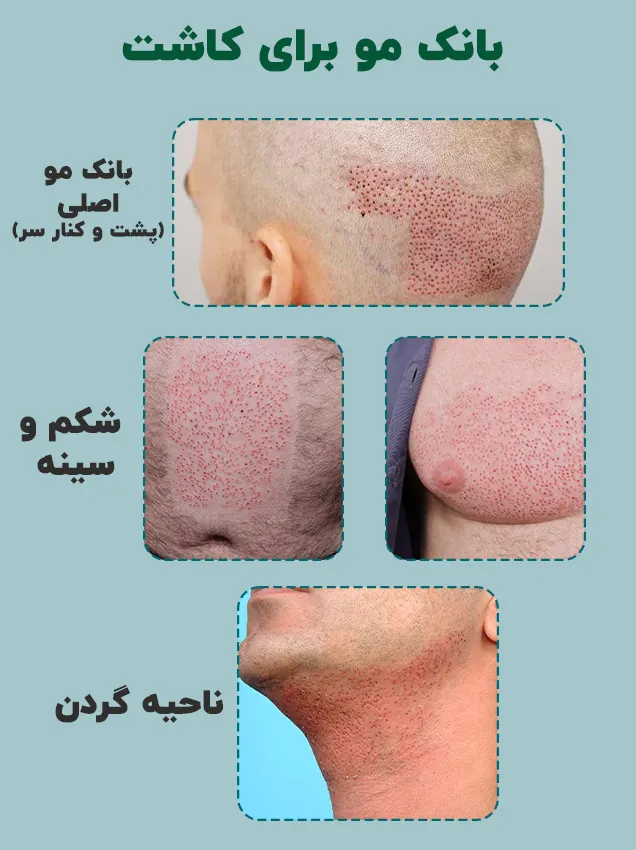 انواع بانک مو برای کاشت