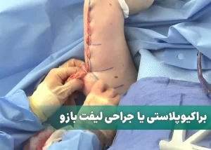 براکیوپلاستی یا لیفت بازو