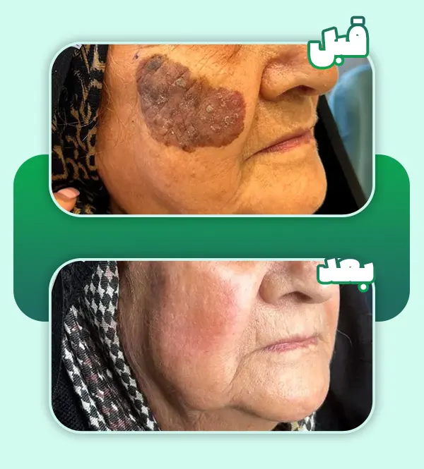 قبل و بعد برداشتن خال