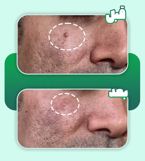 قبل و بعد برداشتن خال