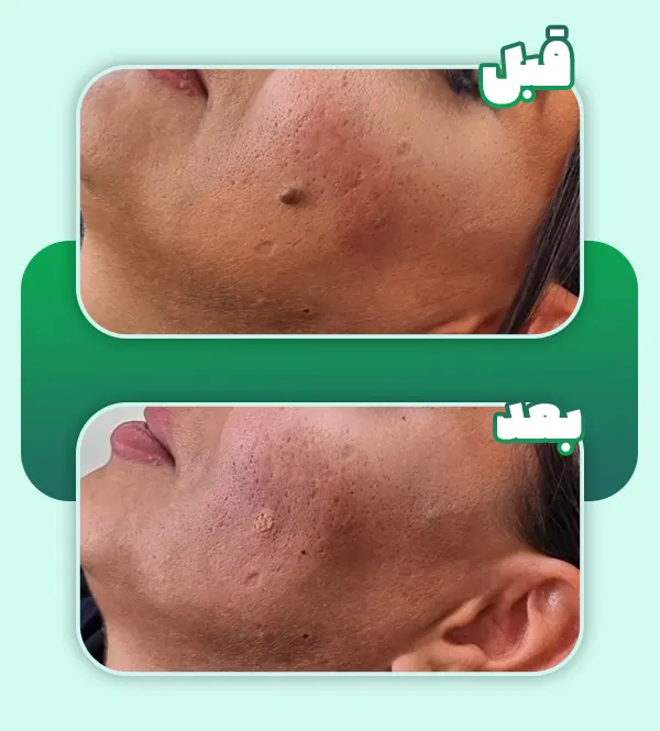 قبل و بعد برداشتن خال