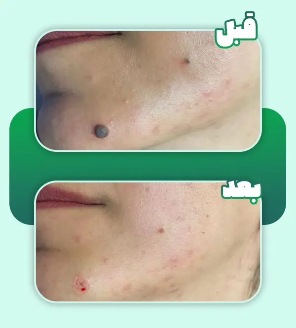 قبل و بعد برداشتن خال