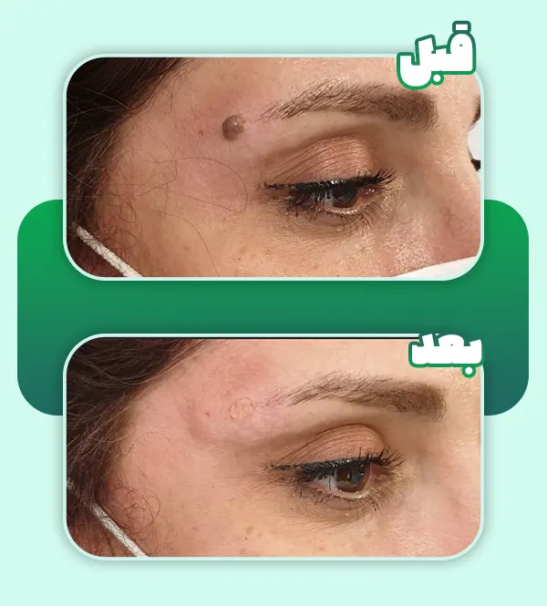 قبل و بعد برداشتن خال