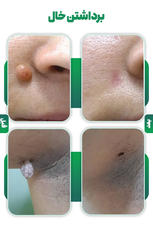 برداشتن خال