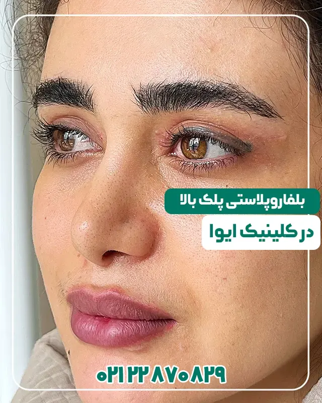 بلفاروپلاستی ایوا