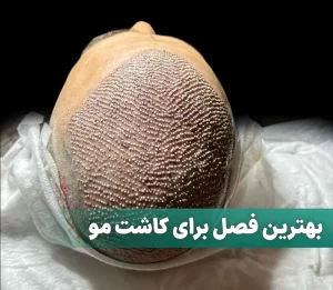 بهترین فصل کاشت مو