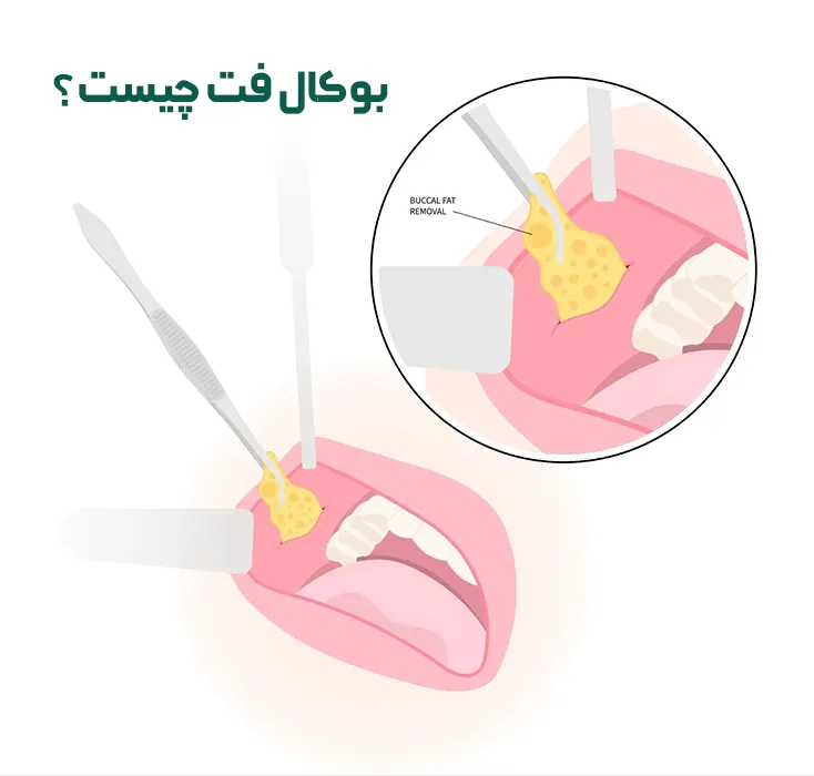 بوکال فت چیست