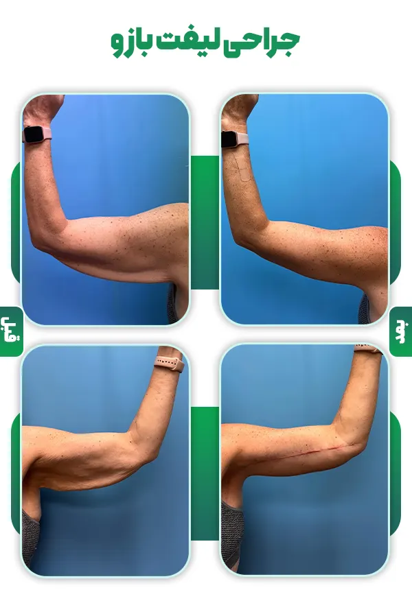 قبل و بعد جراحی لیفت بازو