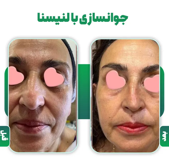 قبل و بعد لنیسنا