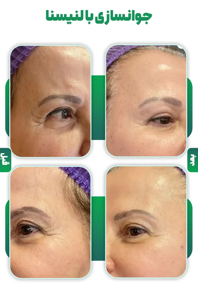 جوانسازی با لنیسنا