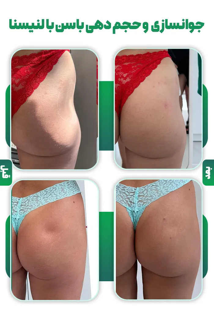 جوانسازی و حجم دهی باسن با لنیسنا