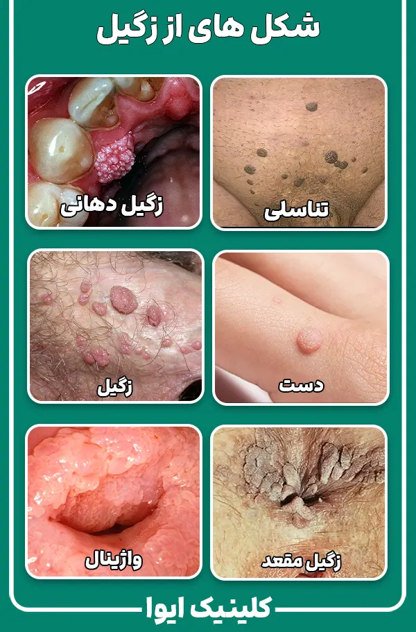 شکل های از زگیل