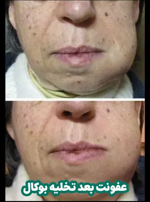 عفونت بعد تخلیه بوکال