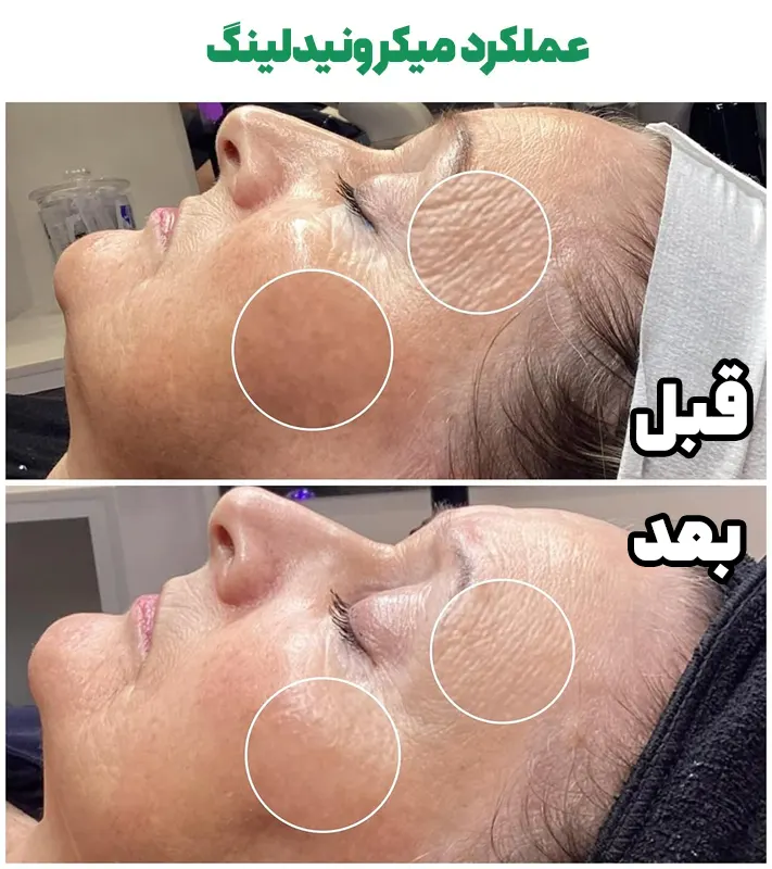 جوانسازی با میکرونیدلینگ